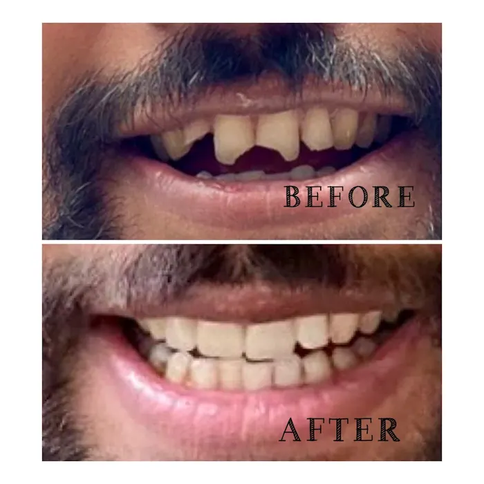 Dentures in Dehradun: What They Cost and What Makes One Fit