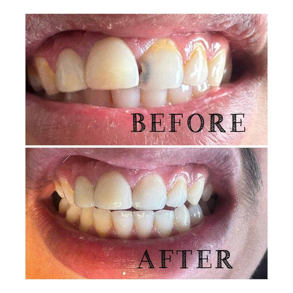 Before and after tooth shade correction at Vital Dental Care, Dehradun