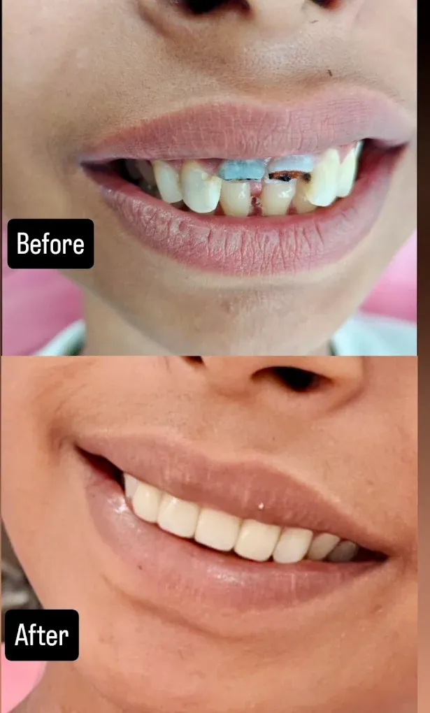 Before and after orthodontic treatment at Vital Dental Care, Dehradun