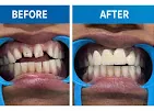 Before and after: cosmetic correction of the upper front teeth, Vital Dental Care Dehradun