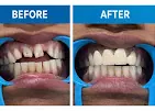 Zirconia or Metal-Ceramic: Choosing a Crown Material