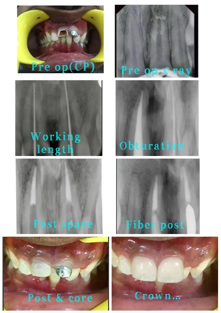 A root canal case shown from X-rays through to the finished crown, Vital Dental Care Dehradun